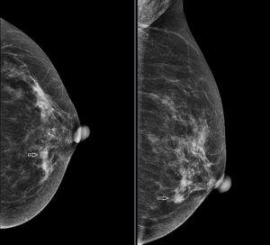 Vai trò của chụp nhũ ảnh (X-quang Tuyến vú) trong  tầm soát và chẩn đoán sớm các bệnh về vú lành tính và ác tính .