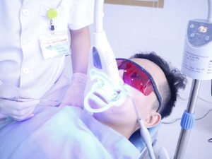 HOÀN MỸ BẮC NINH: TẨY TRẮNG RĂNG WHITEMAX – GIẢI PHÁP TỐI ƯU KHẮC PHỤC RĂNG Ố VÀNG, XỈN ĐEN