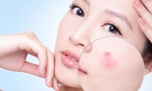 HOÀN MỸ BẮC NINH: 80% NGƯỜI TRỊ MỤN SAI Ở NHỮNG CHI TIẾT NHỎ NÀY — BẠN CÓ ĐANG MẮC?