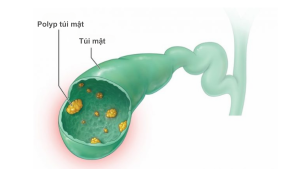 HOÀN MỸ BẮC NINH: POLYP TÚI MẬT – CÓ NGUY HIỂM KHÔNG?