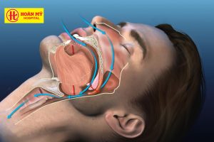 HOÀN MỸ BẮC NINH: NGÁY TO, NGỦ KHÔNG SÂU? ĐỪNG BỎ QUA NGUY CƠ NGƯNG THỞ KHI NGỦ