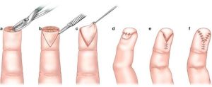 HOÀN MỸ BẮC NINH: PHẪU THUẬT ĐIỀU TRỊ VẾT THƯƠNG NGÓN TAY BẰNG VẠT DA TẠI CHỖ